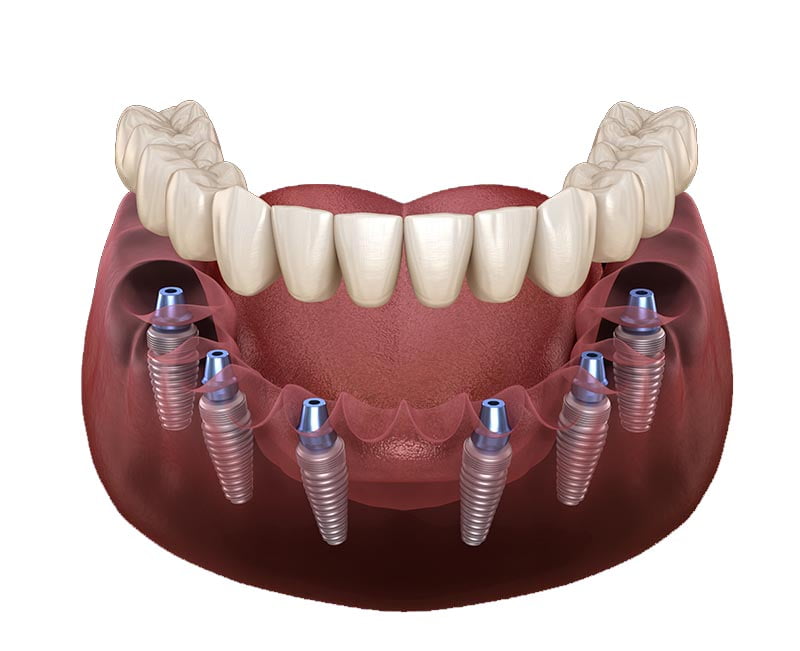 All-on-6 - dental implant in turkey زراعة الأسنان الكلي علي 6 في تركيا