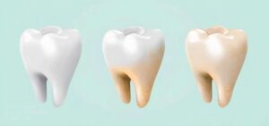 Stains and Teeth Discoloration البقع وتلون الأسنان
