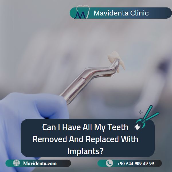 Full Mouth Extraction and Dental Implants