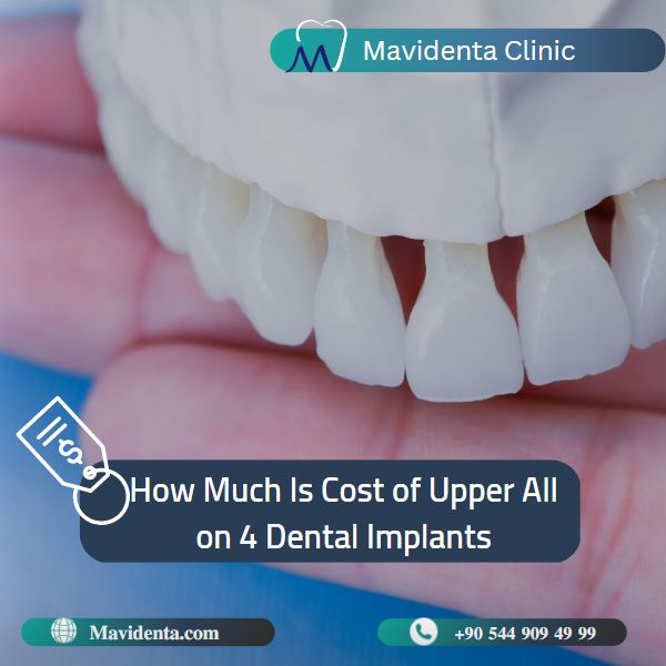 Cost Of Upper All On 4 Dental Implants