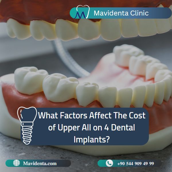 Cost of Upper All on 4 Dental Implants
