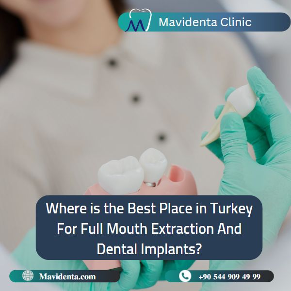 Full Mouth Extraction and Dental Implants