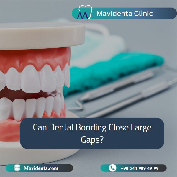 Dental Bonding Front Teeth Gap Cost 