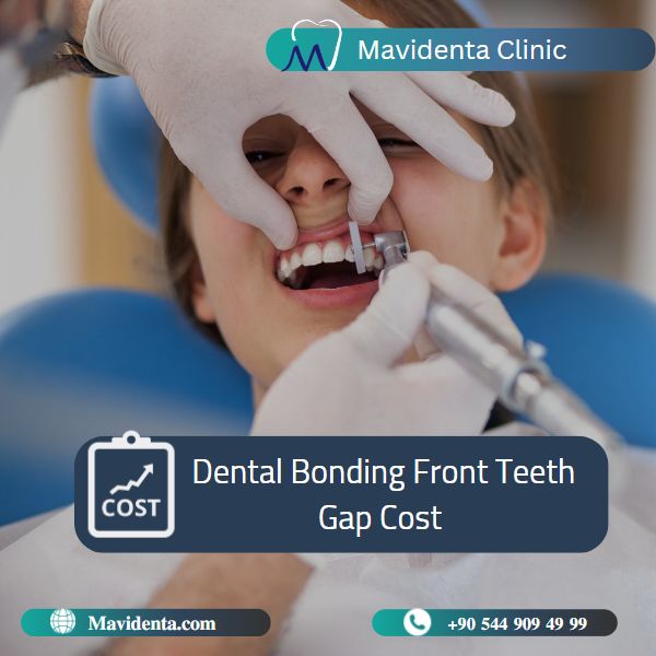 Dental Bonding Front Teeth Gap Cost 