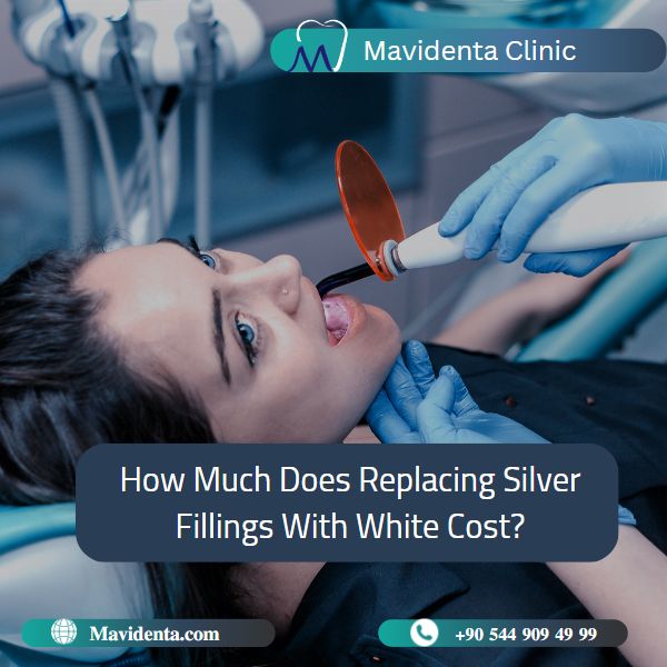 Replacing Silver Fillings With White Cost  