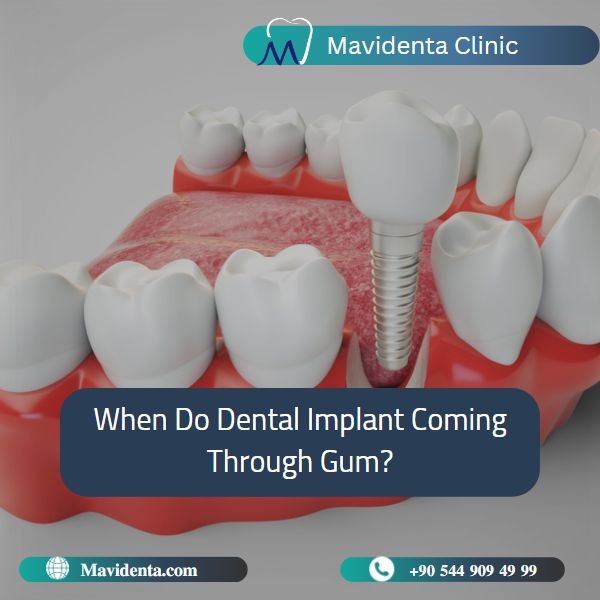 Dental Implant Coming Through Gum