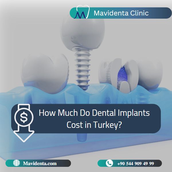 Why Are Dental Implants Cheaper In Turkey 