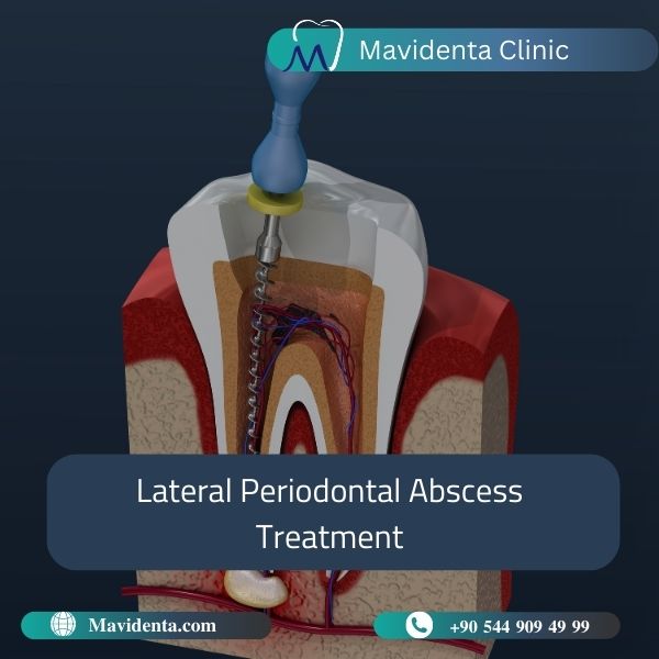 Lateral Periodontal Abscess Treatment