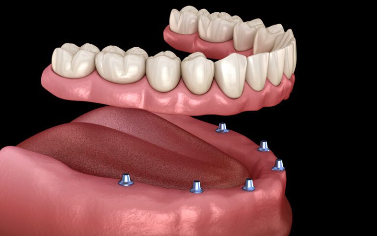 All-On-6 - Dental Implant In Istanbul ﻿ زراعة الأسنان الكل على 6 Зубные Имплантаты &Quot;Все-На-6&Quot;