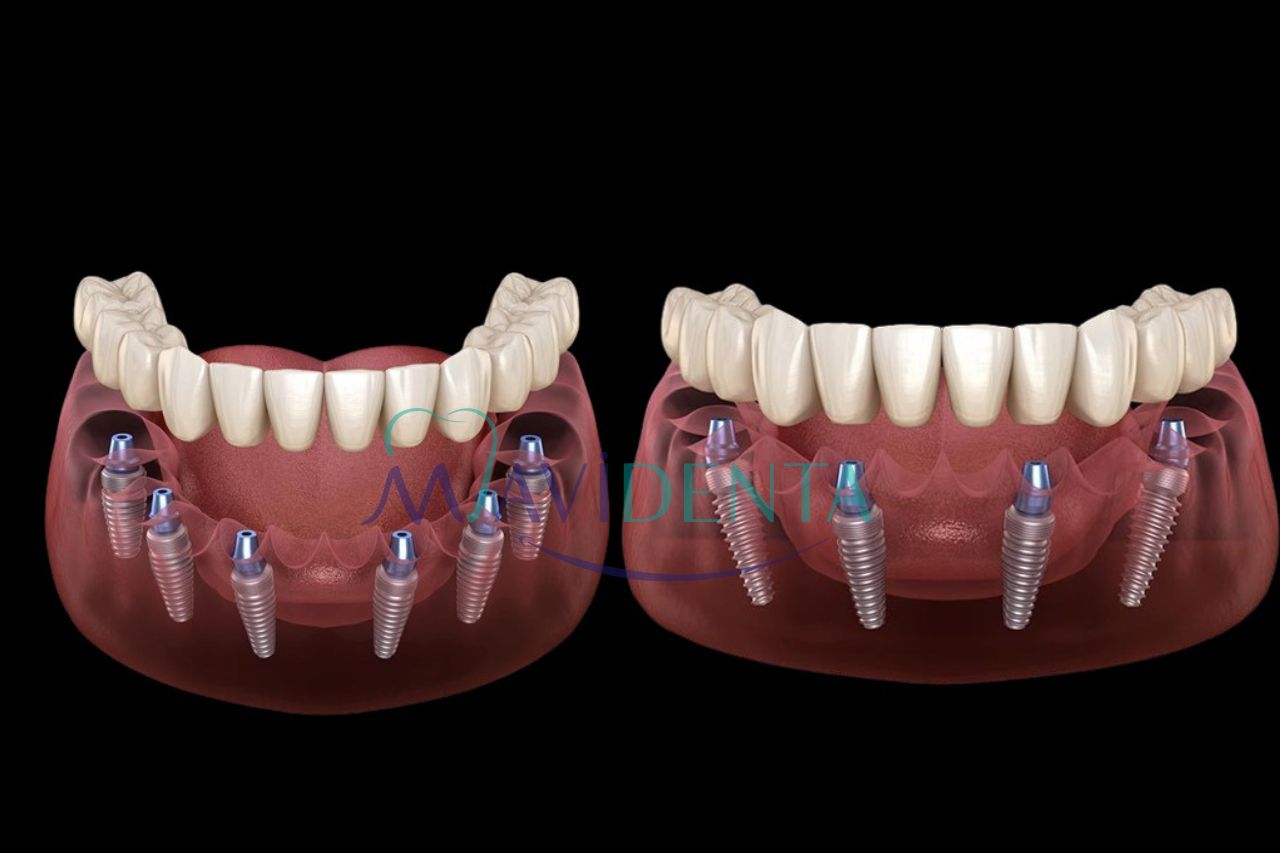 All on 4 vs All on 6 dental implants