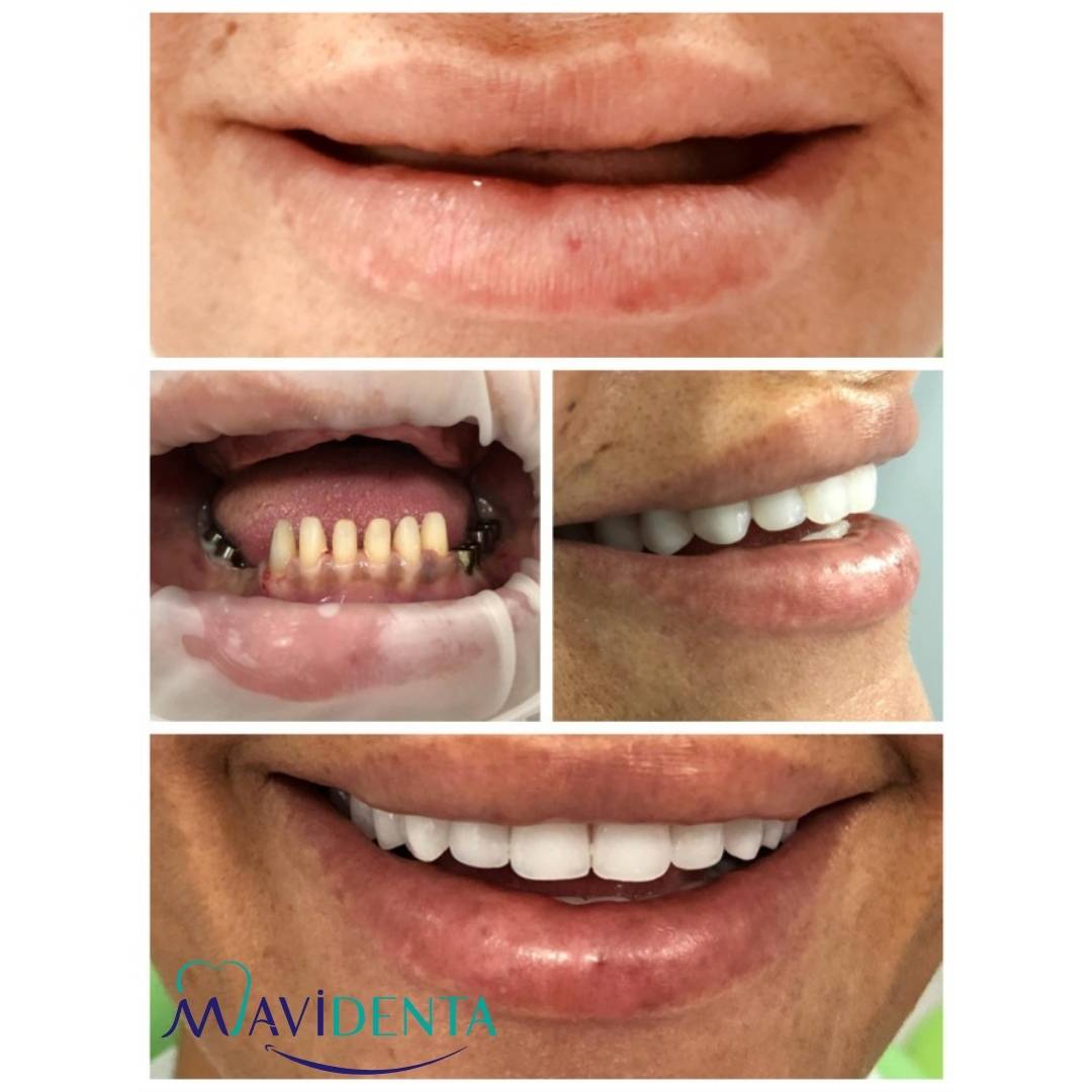 Before And After Our Patient Getting Her Hollywood Smile
