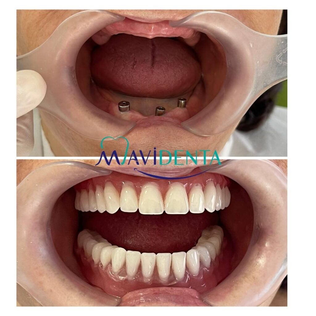dental implant and Porcelain crowns