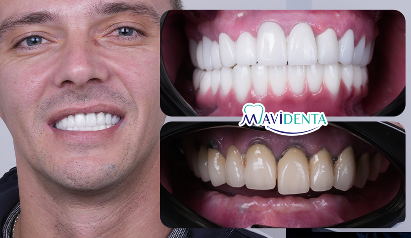 Best Dental Implant Clinic in Istanbul
