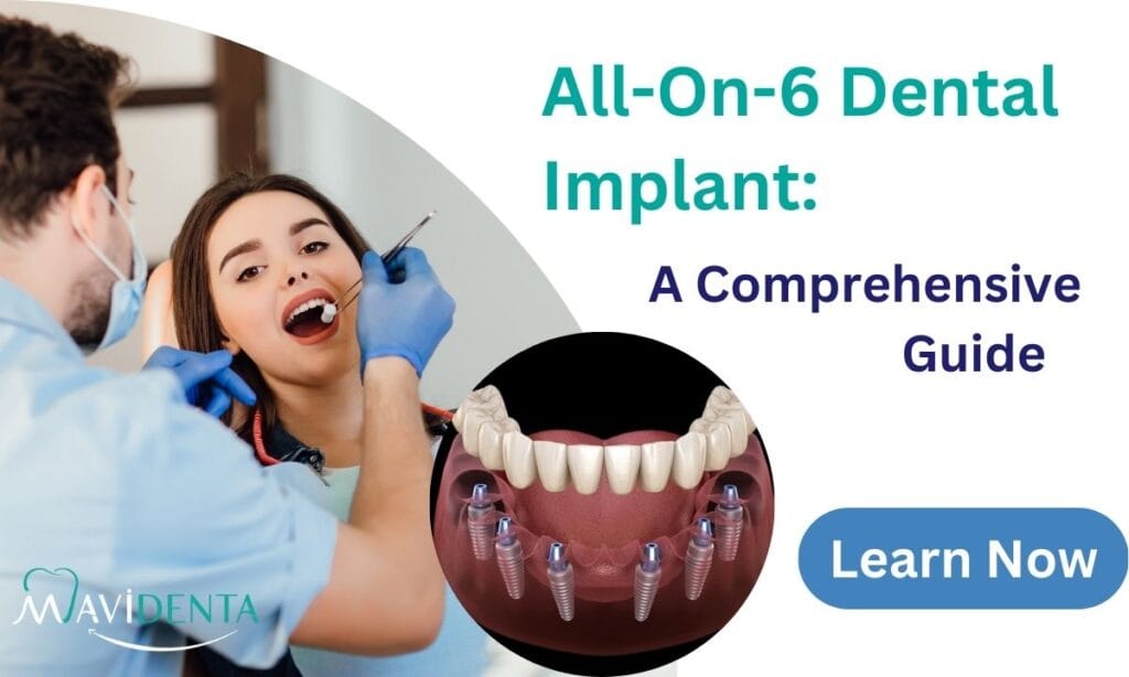 All-On-6 Dental Implant