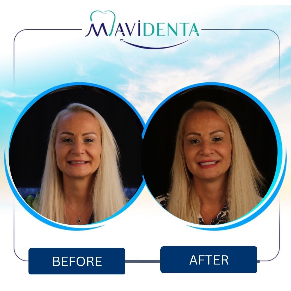 Before and After E-max Veneer