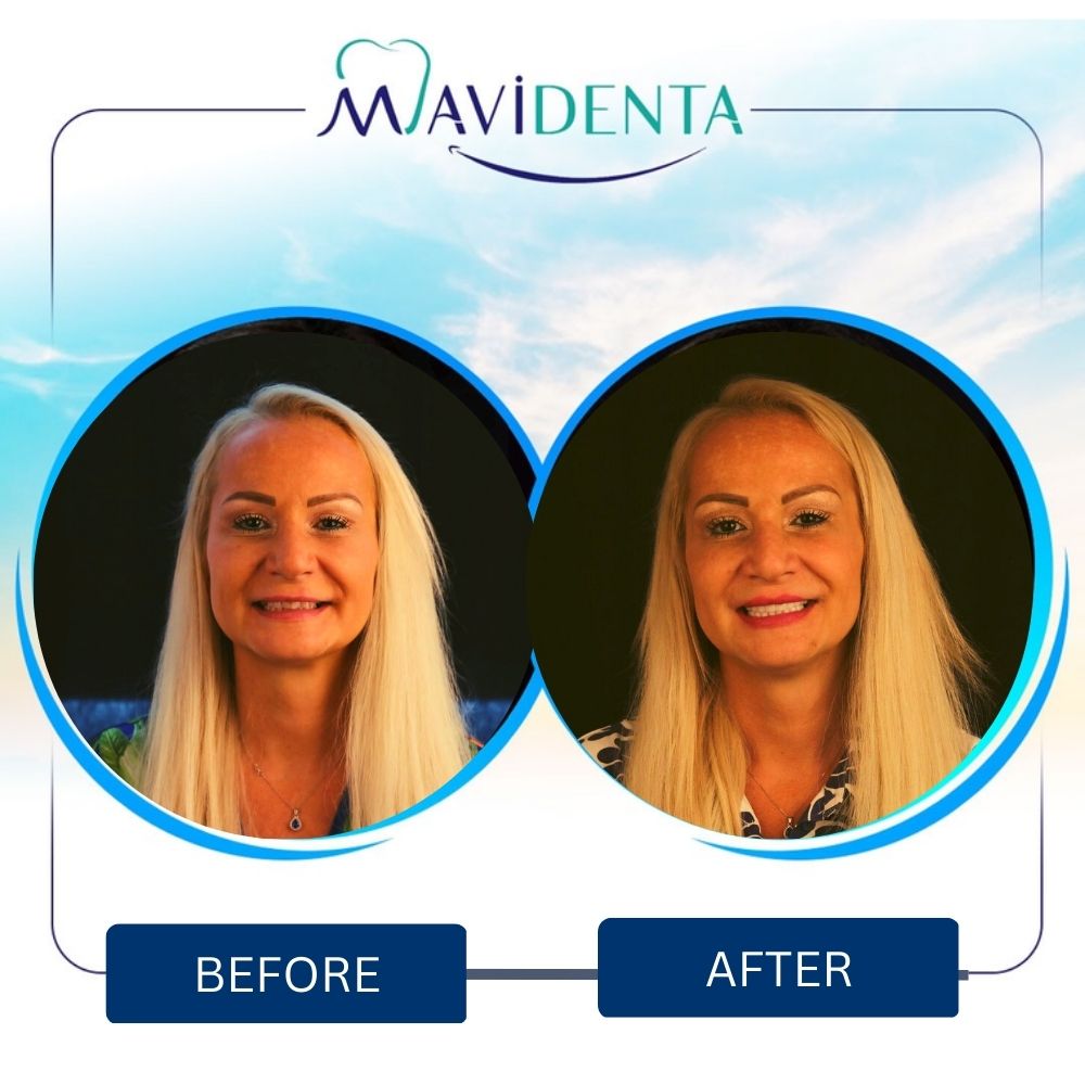 Before and After E-max Veneer in Mavidenta Dental Clinic in Istanbul
