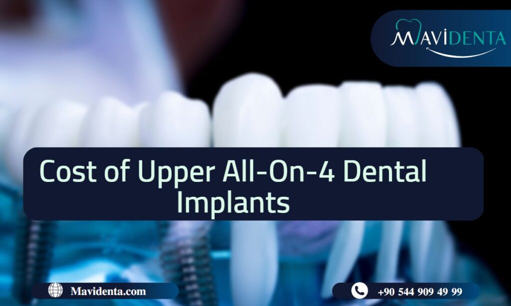 Cost of Upper All on 4 Dental Implants