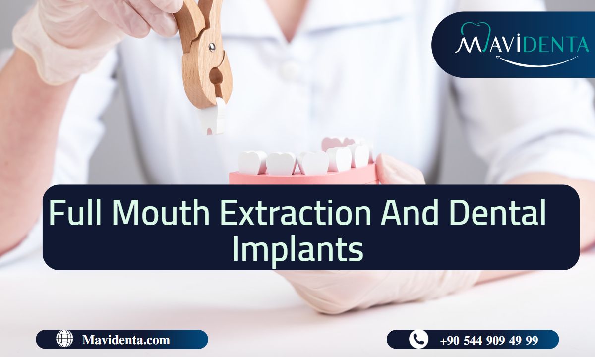 Full Mouth Extraction and Dental Implants