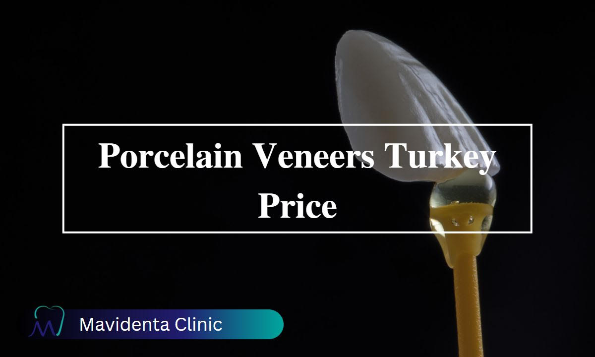 Porcelain Veneers Turkey Price