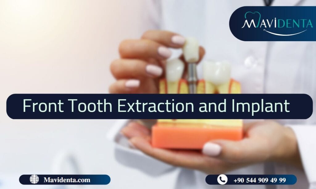 Front Tooth Extraction and Implant