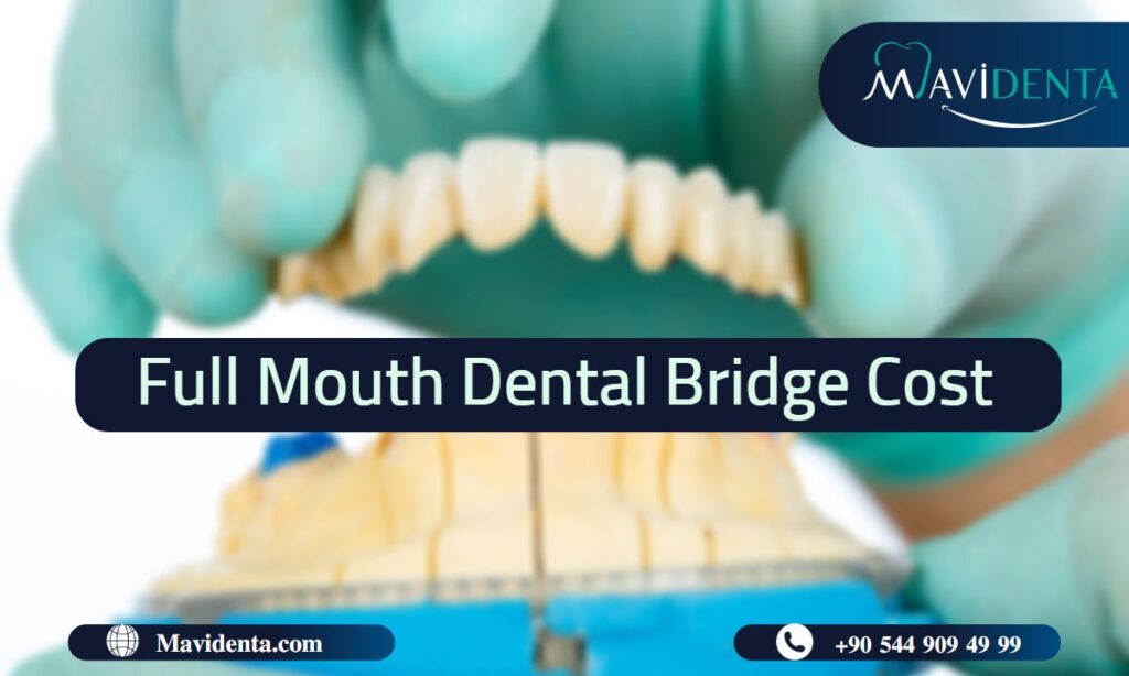 Full mouth dental bridge cost