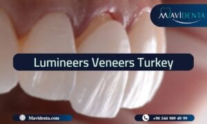 Цены на люминиры в Турции: доступная красивая улыбка Lumineers Veneers Turkey