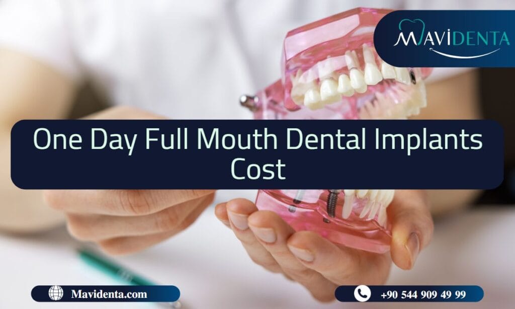 One Day Full Mouth Dental Implants Cost