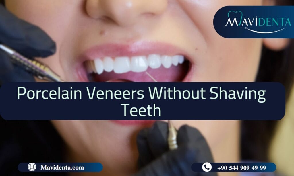Porcelain Veneers Without Shaving Teeth