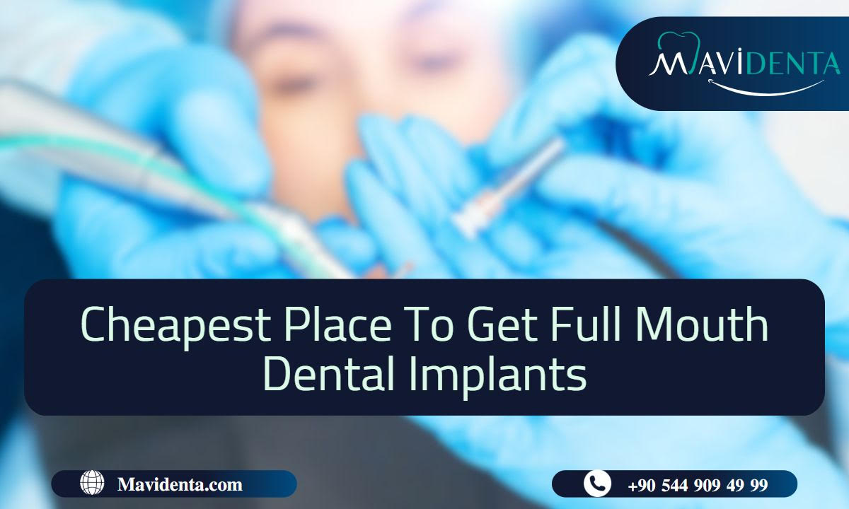 Cheapest Place To Get Full Mouth Dental Implants