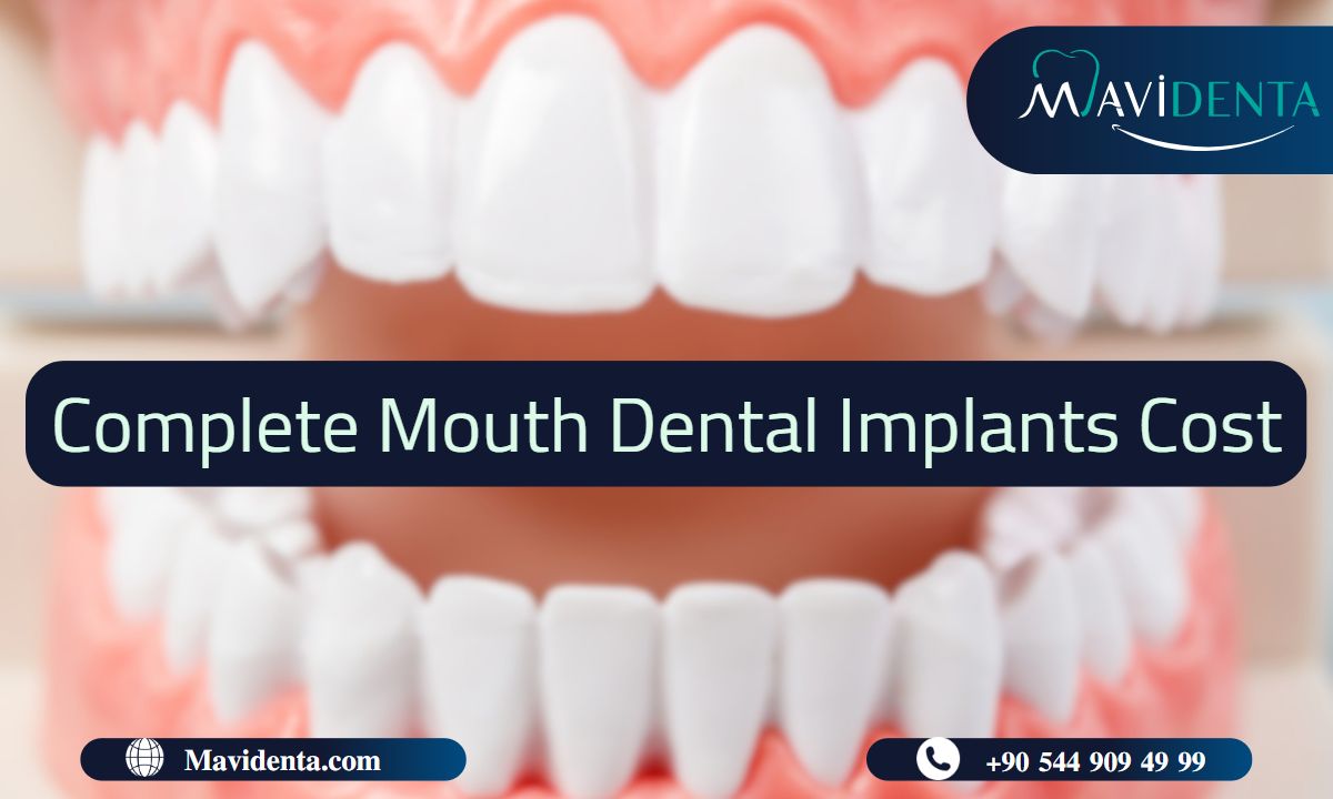 Complete Mouth Dental Implants Cost