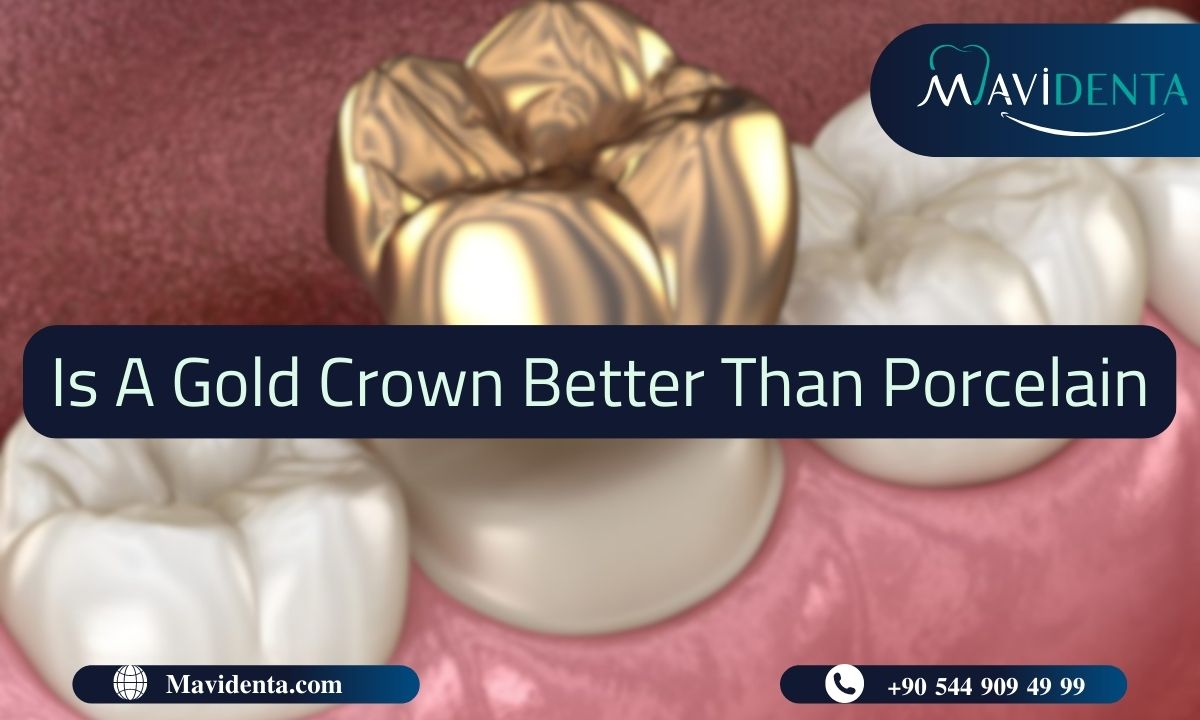 Is A Gold Crown Better Than Porcelain