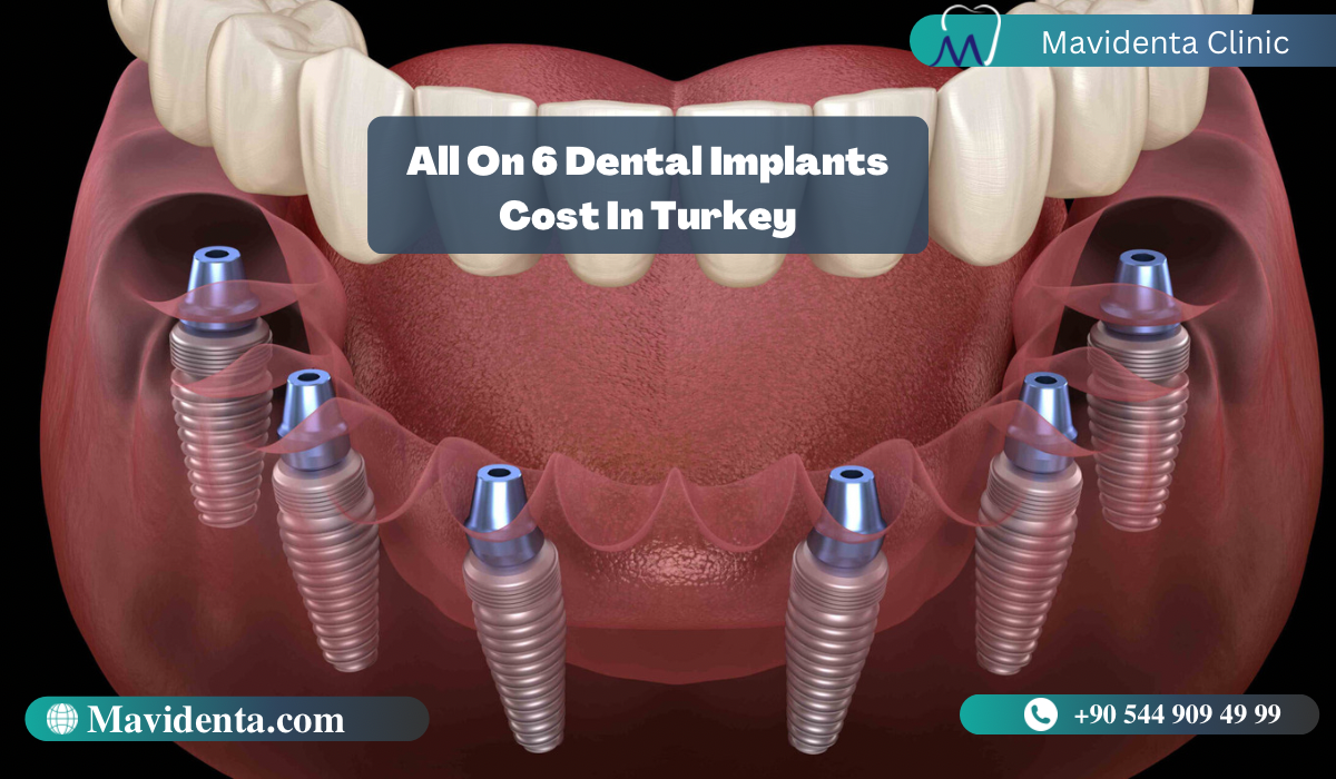 All On 6 Dental Implants Cost In Turkey