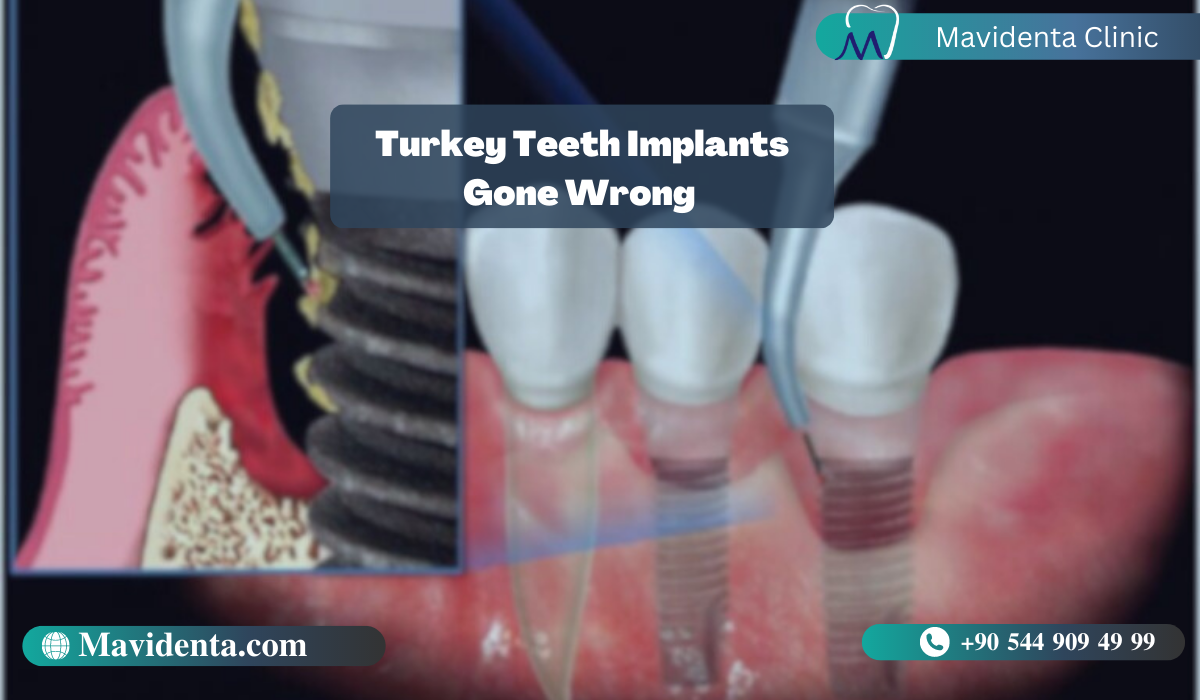 Turkey Teeth Implants Gone Wrong