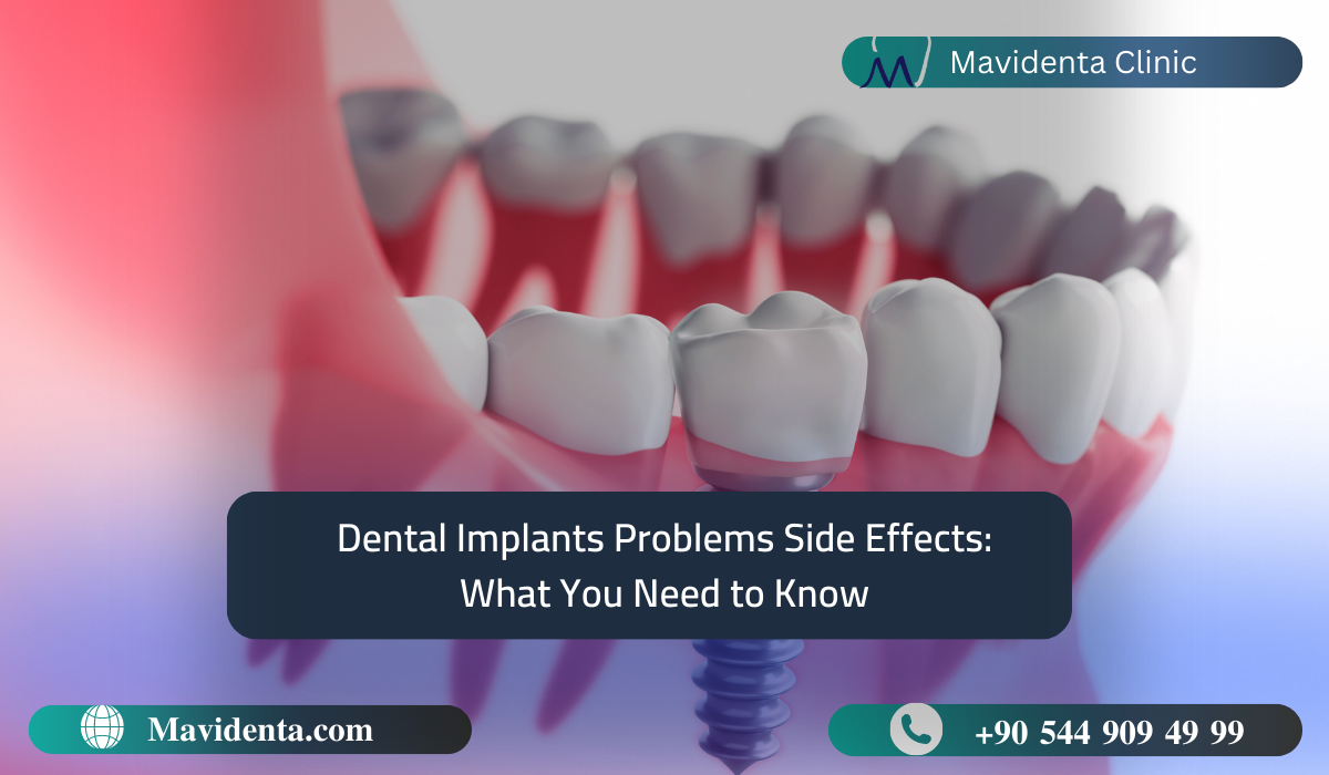 Dental Implants Problems Side Effects : What You Need to Know