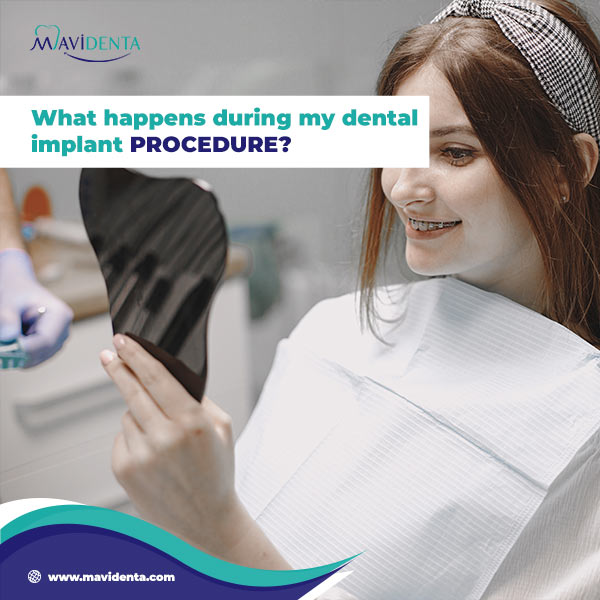 What Happens During My Dental Implant Procedure?