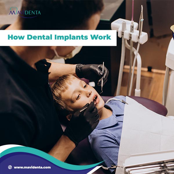 What Is A Dental Implant Made Of