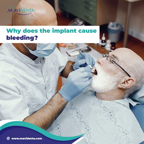 How To Stop Bleeding While On Implant How To Stop Bleeding While On Implant