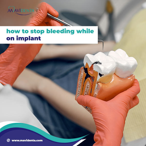 How To Stop Bleeding While On Implant ?
