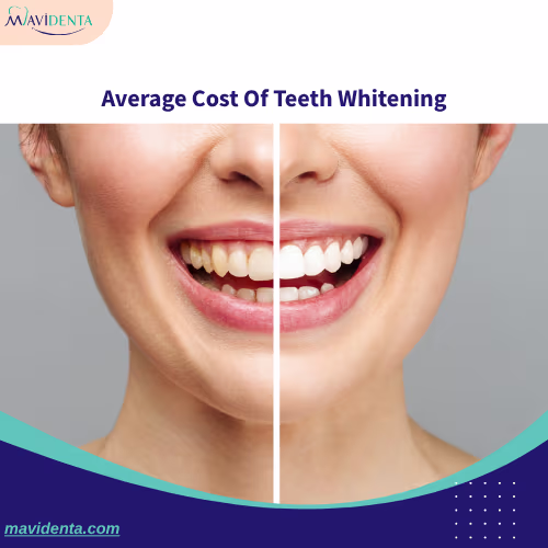 Average Cost Of Teeth Whitening