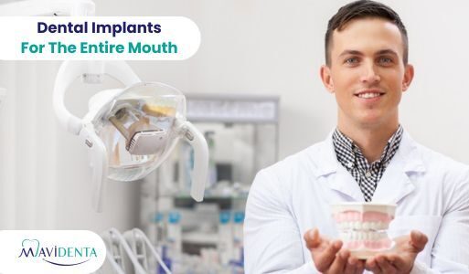 Dental Implants For The Entire Mouth