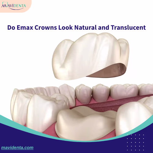 Do Emax Crowns Look Natural and Translucent