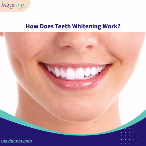 How Does Teeth Whitening Work