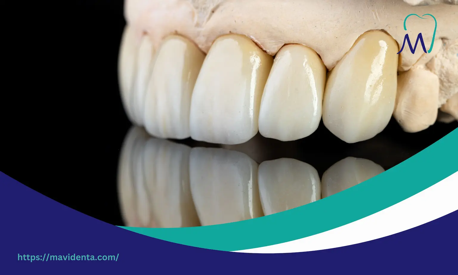 Zirconium Crowns Vs Veneers