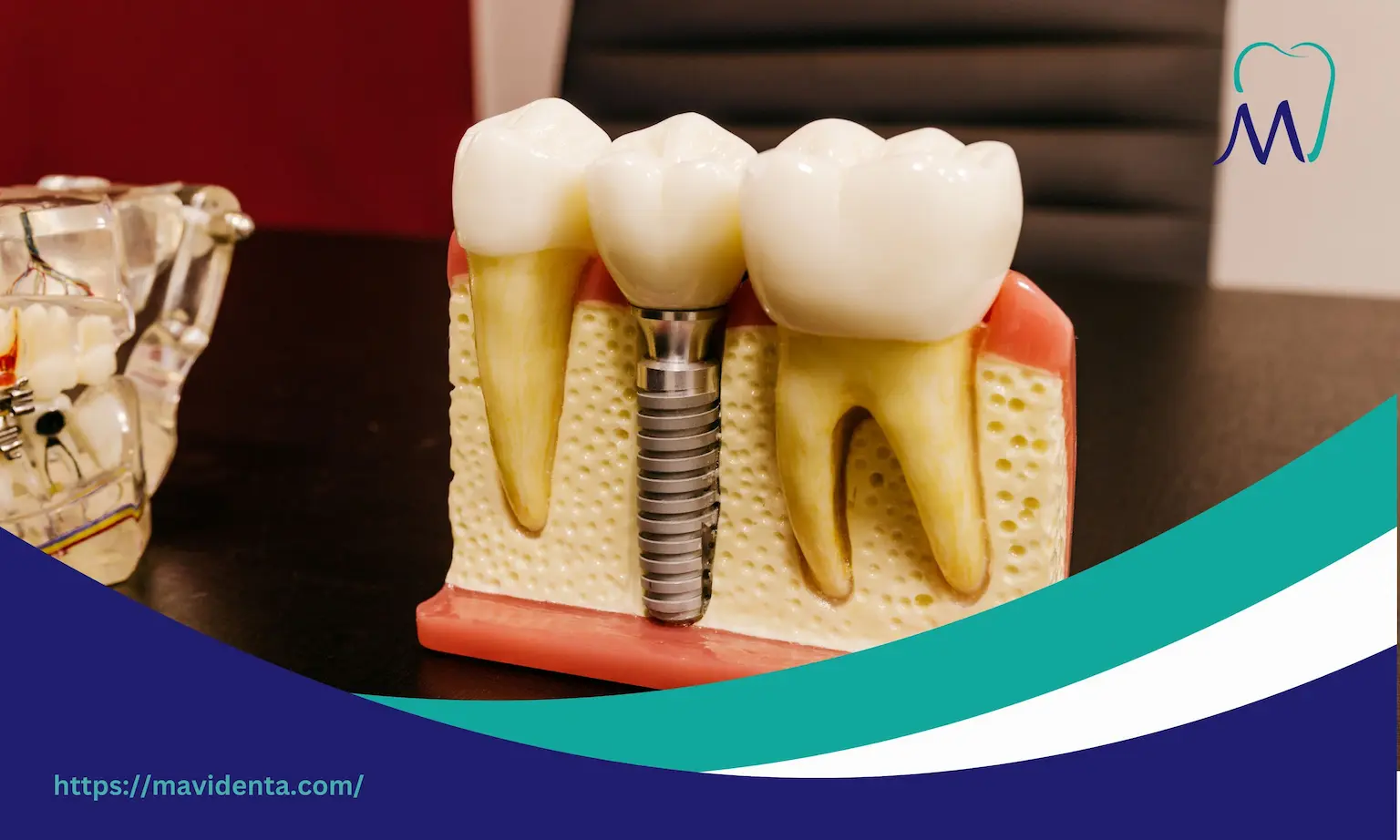 Cost of All on 4 Dental Implants Turkey  Cost of All on 4 Dental Implants Turkey