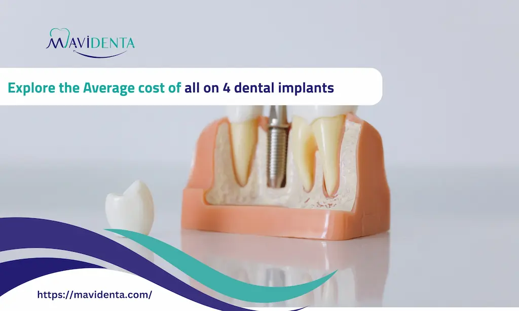 Average cost of all on 4 dental implants