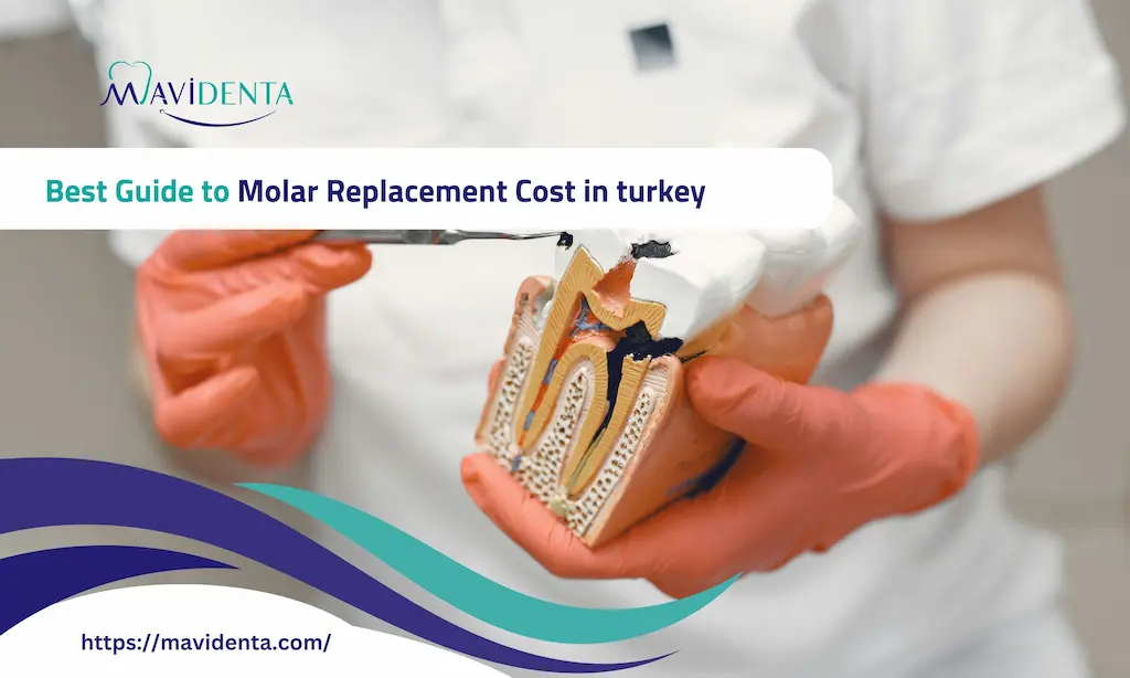 Molar Replacement Cost in turkey