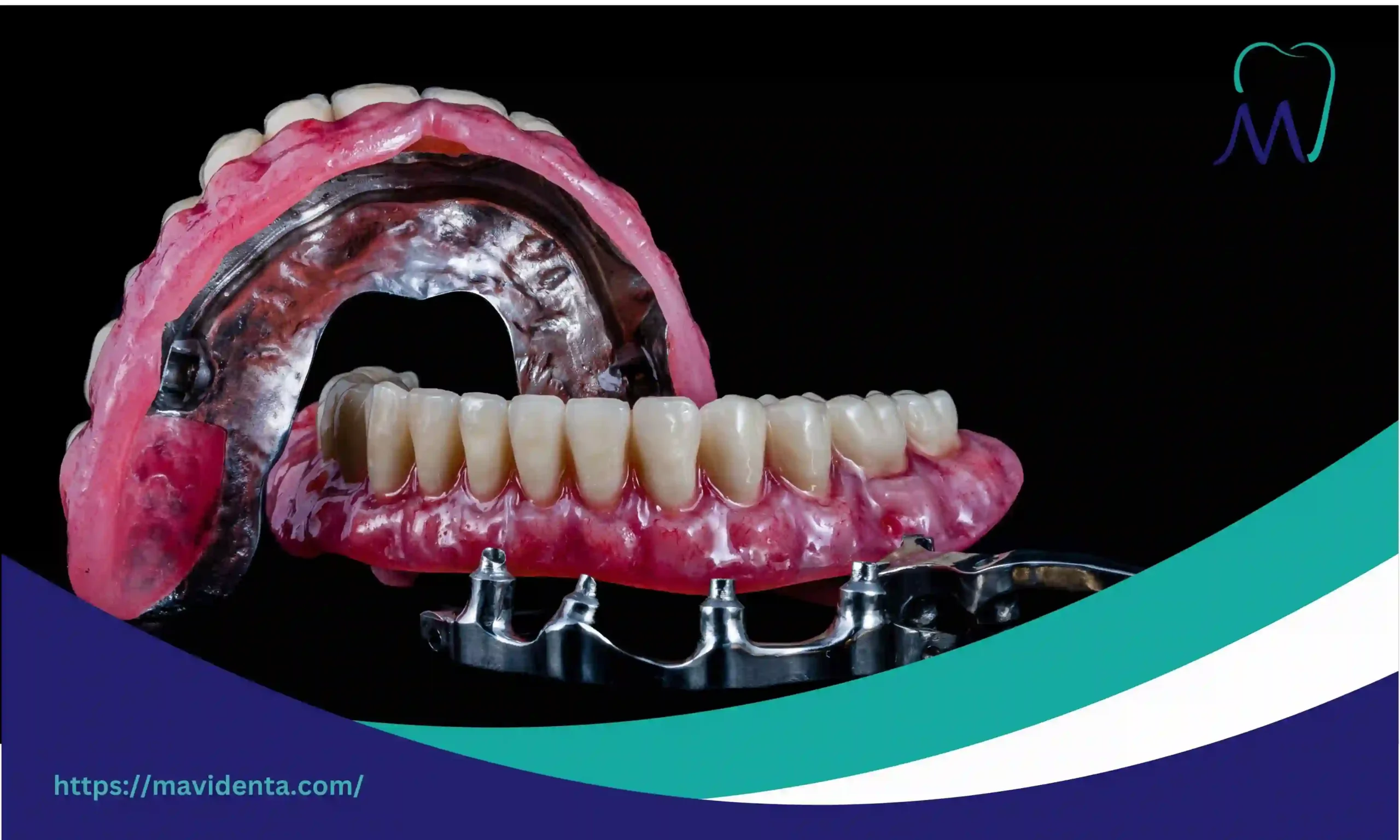 average cost of 4 dental implants average cost of 4 dental implants