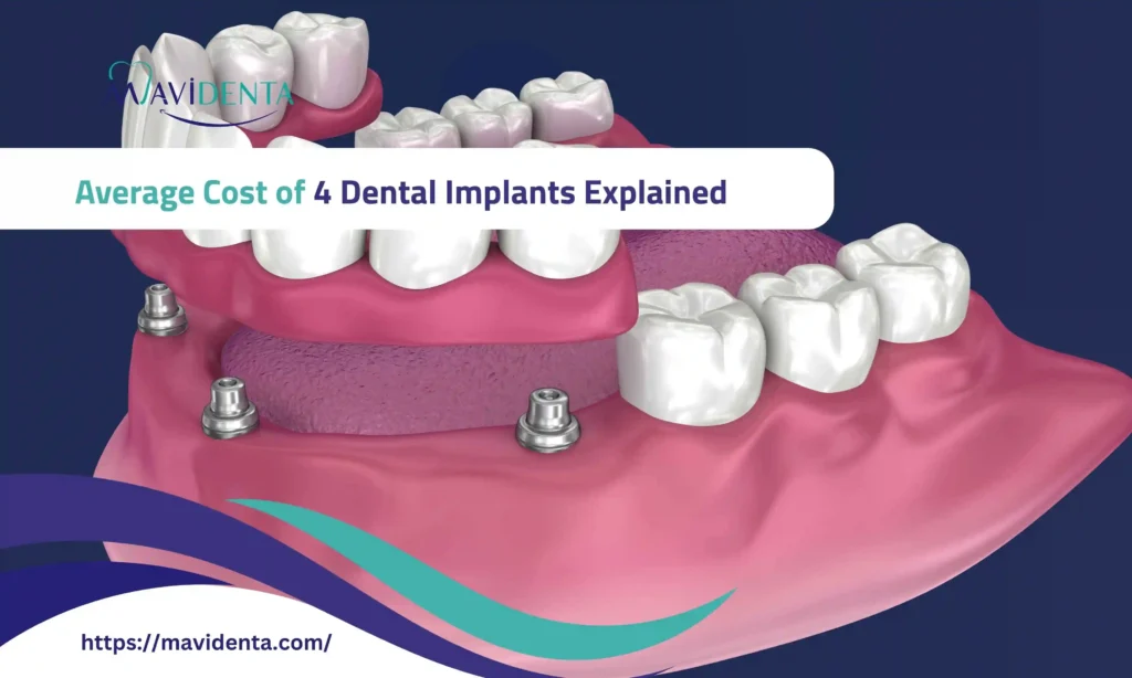 average cost of 4 dental implants
