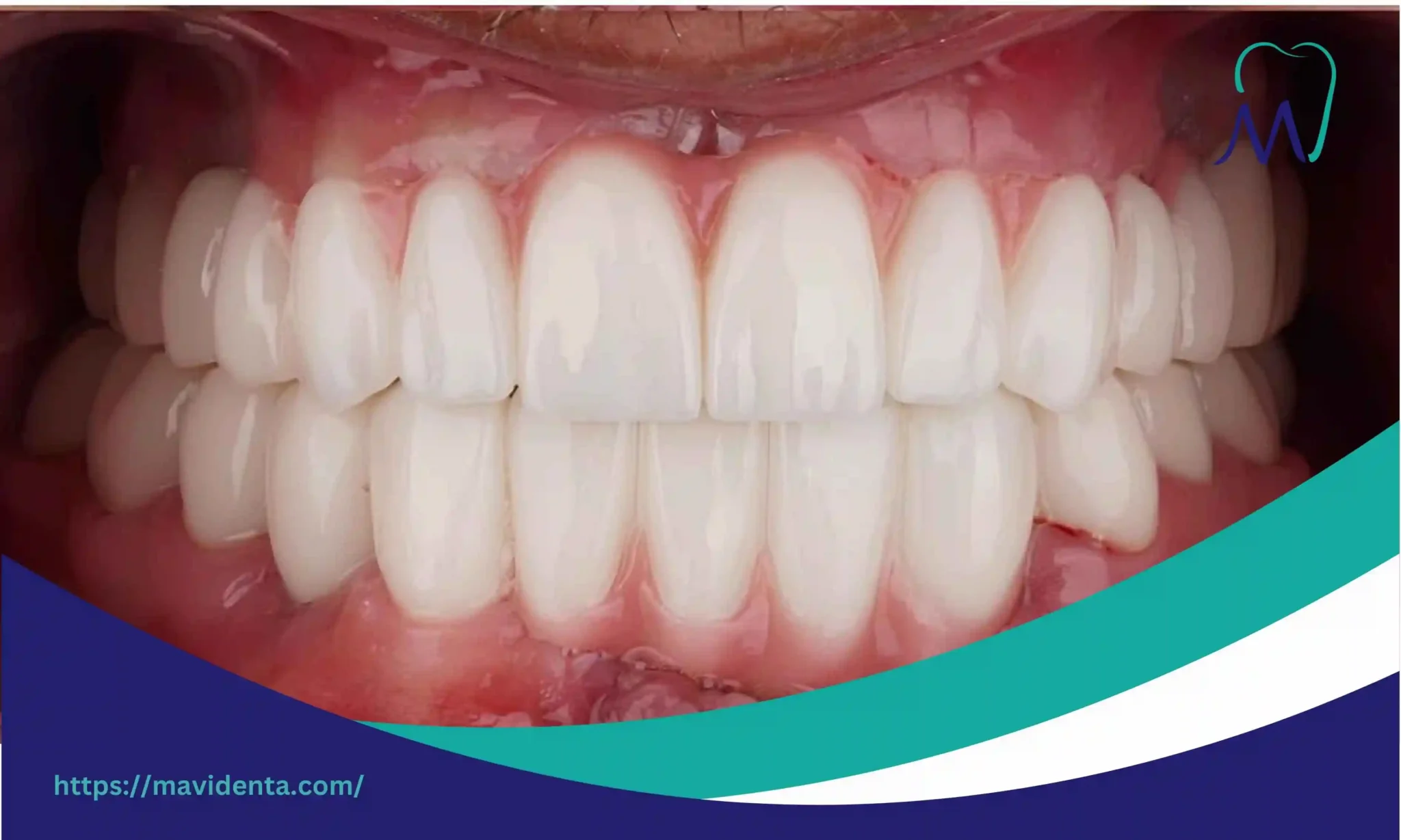 cost of zygomatic dental implants cost of zygomatic dental implants