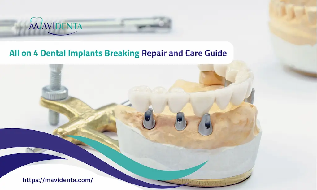 All on 4 Dental Implants Breaking